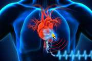 اختلال عملکرد گره سینوسی و کاشت ضربان ساز دائمی پس از جراحی های بزرگ قلب