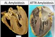 چالش‌های تشخیصی و درمانی در آمیلوئیدوز قلبی پیش‌رونده سریع