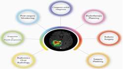 تکنیک‌های یادگیری عمیق در تقسیم‌بندی تومور گلیوما با MRI