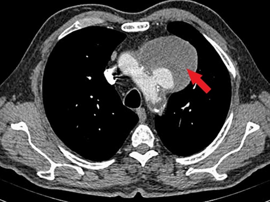 Chest CT scan with contrast, axial view. Huge aortic arch aneurysm with significant mural thrombosis inside it (arrow) {faces}