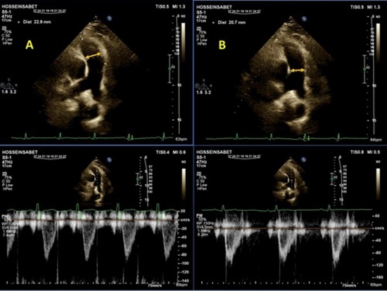 A This image showcases the measurement of the distal portion of the right ventricular outflow tract diameter at systole using 2D {faces}