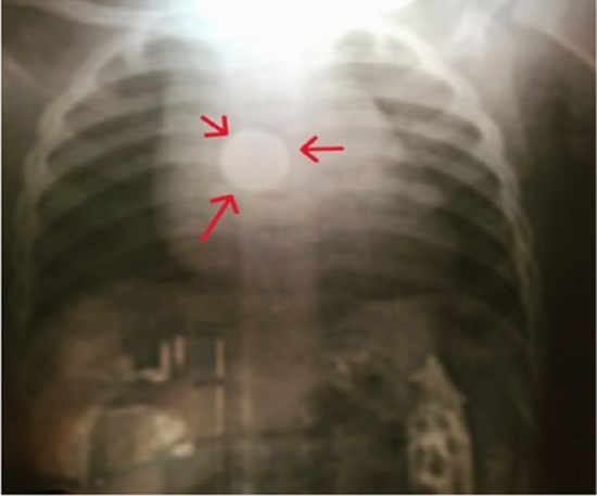 The patient's chest x‐ray showed a round‐shape foreign body in the middle of the thoracic esophagus. The diameter was measured t {faces}