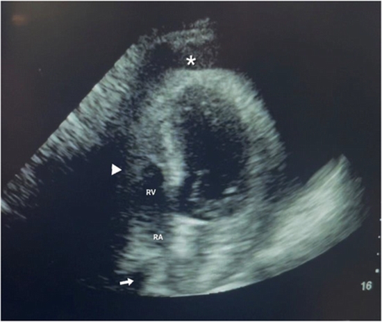 Transthoracic echocardiogram {faces}