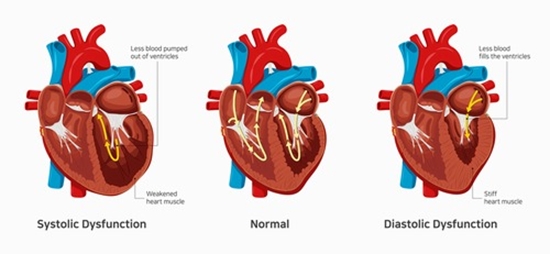 diastolic dysfunction {faces}