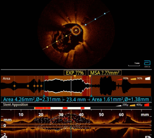 نجات قلب با تصویربرداری پیشرفته: داستان غلبه بر لخته مکرر داخل استنت
